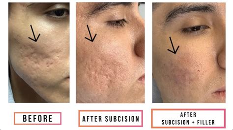 subcision acne scars before and after - Captions Guru