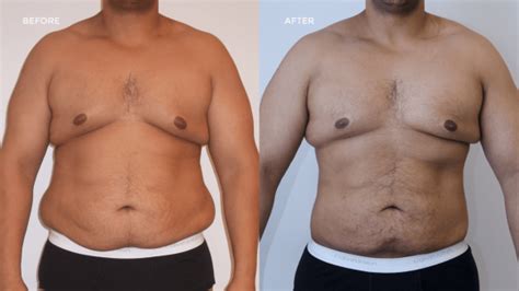 Liposuction – Dr. Muhammad Waqas Javed – Best Plastic Surgeon in Multan