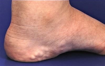 Little Balls On The Heel Of My Foot Sale | emergencydentistry.com