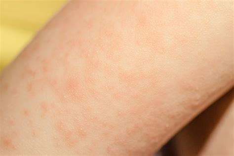 Fibromyalgia Rash: Tips to Manage Rashes and Other Skin Problems ...