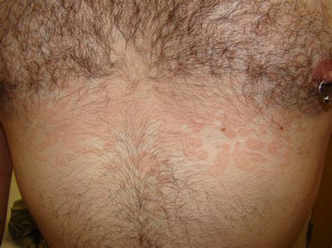 Brown Spots On Chest