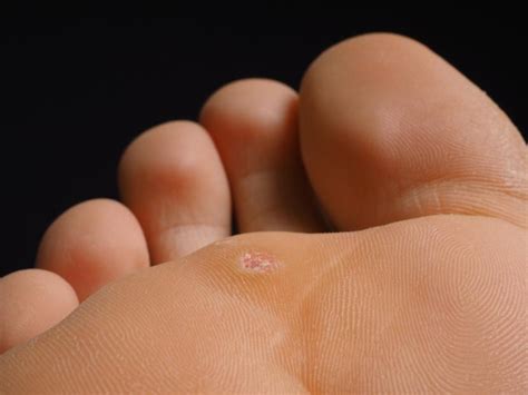 All About Plantar Warts