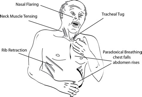 Recognizing Airway Obstruction May Save Your Patient's Life