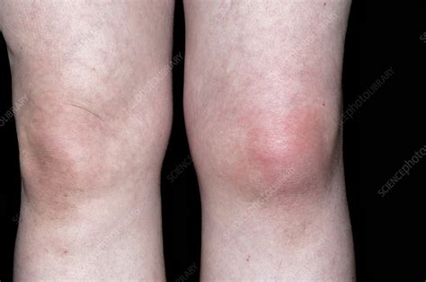 Gout of the knee joint - Stock Image - C011/0420 - Science Photo Library