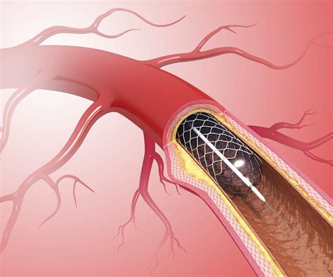 escanear Campo Polar blocked artery in heart stent Lima trolebús arcilla