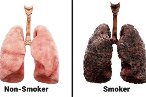 Effects of smoking on lungs