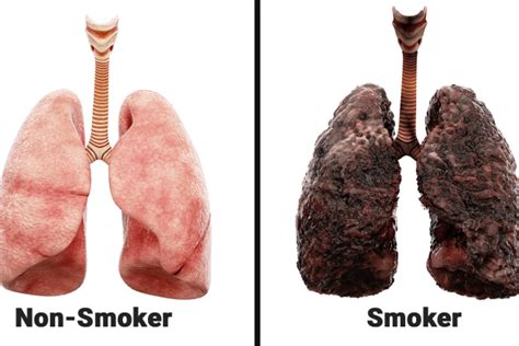 Smoking Lungs Before And After