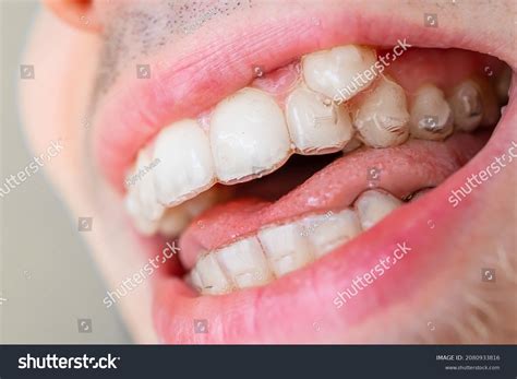 The Ugliest Teeth In The World
