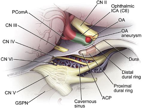 22 Ophthalmic Artery Aneurysms | Neupsy Key