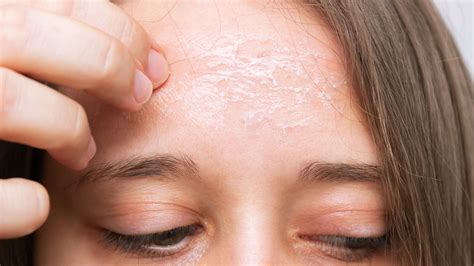 Why The Skin On Your Forehead May Be Flaking