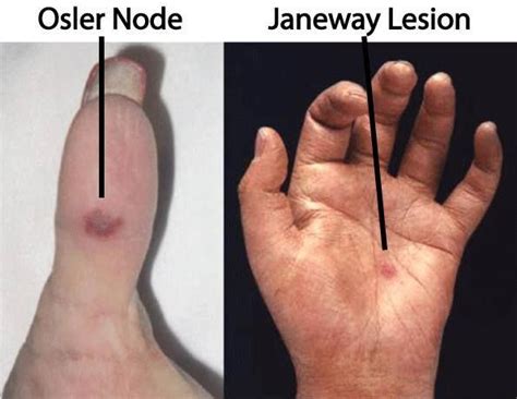 Janeway Lesions | Janeway, Nurse practitioner school, Nurse