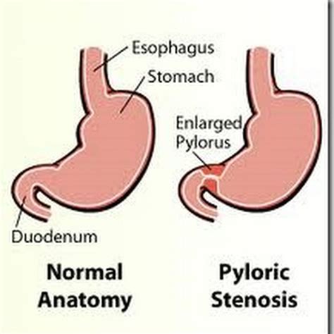 Pyloric Stenosis, Pyloric Obstruction, Stomach Outlet Obstruction, Causes, S/S, Treatment ...
