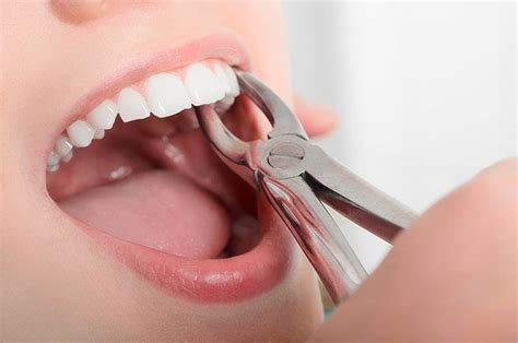 Tooth Extraction | Causes, Procedure & Recovery, Cost, Risks