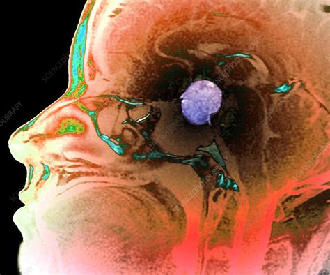 Pituitary macroadenoma, MRI scan - Stock Image - C052/9123 - Science ...