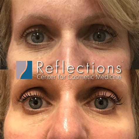 Under Eye Wrinkles Treated with Botox Injections Before & After Photos New Jersey - Reflections ...