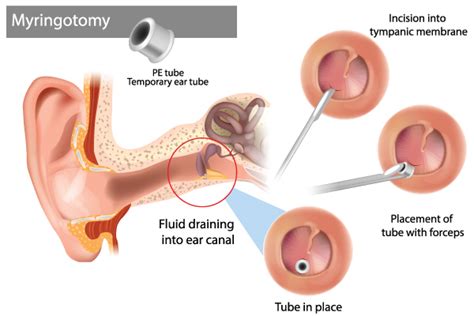 Pediatrics Ear Tube Services Atlanta, GA | Pediatric Ear Infection Treatment