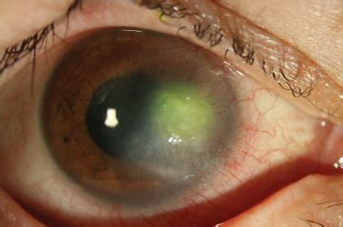 An Update on Advances in Diagnosis and Treatment of Acanthamoeba Keratitis - touchOPHTHALMOLOGY