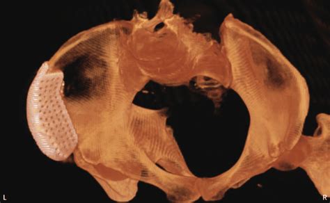 Postoperative CT of iliac restoration. | Download Scientific Diagram