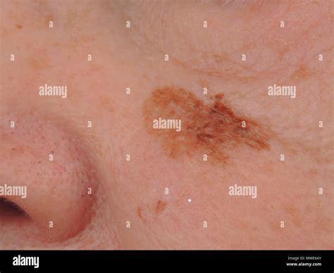 Lentigo Melanoma : Man With A Lentigo Maligna Melanoma Series Stock Photo Download Image Now ...