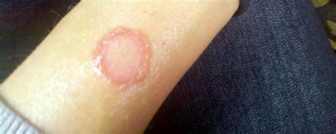 The 11 Best at Home Remedies for Ringworm | NaturalAlternativeRemedy