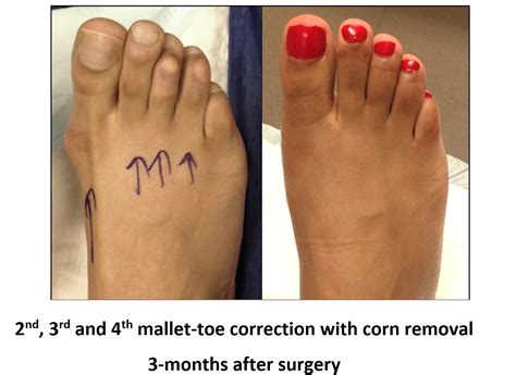 Toe Deformities