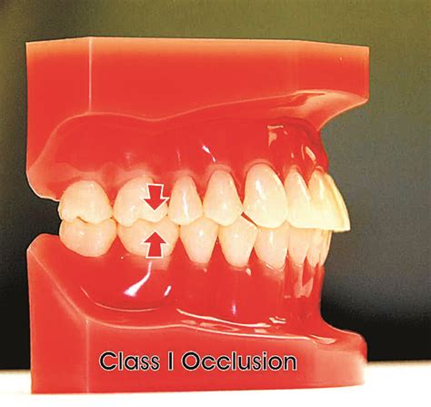 Class I Occlusion | Oral surgeon, Oral health care, Hygiene care