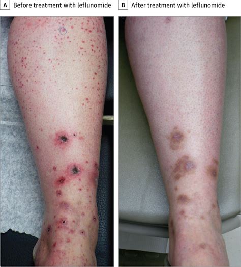 Treatment of Cutaneous Small Vessel Vasculitis With Leflunomide | JAMA ...