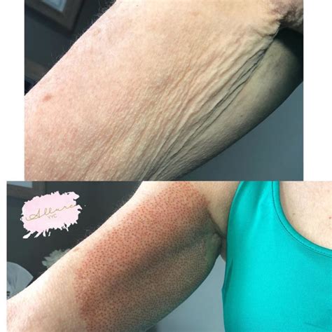 Flabby Arms Skin Tightening in Tucson - Fibroblast PlasmaAlternatives ...