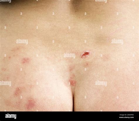 Shingles. View of a blistering rash on the buttocks of a patient with ...