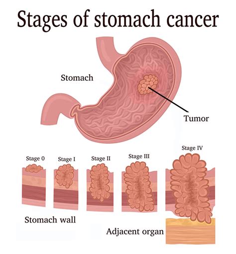 Stomach Cancer - Saint John’s Cancer Institute