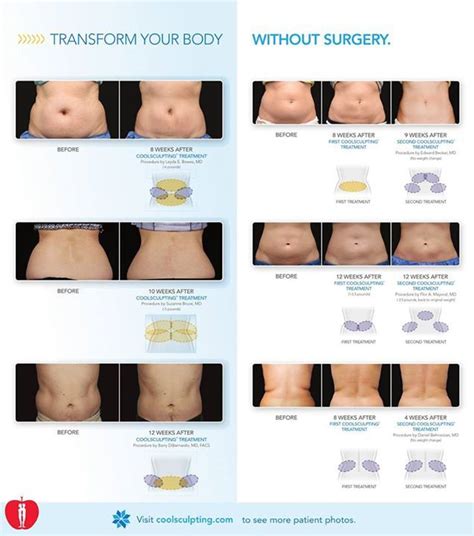 Transform you Body without Surgery. #health #CoolSculpting | Cool sculpting, Body, Surgery