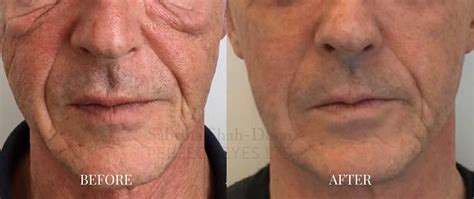 Skin Tightening Morpheus8 Before And After Pictures | Thebrokensealblog