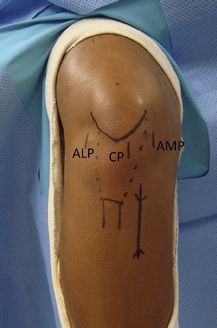 Outside appearance of a right knee showing the portal placement. ALP... | Download Scientific ...