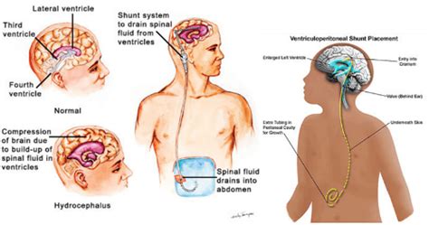 Ventriculoperitoneal Shunt India Reviews: Is it effective?