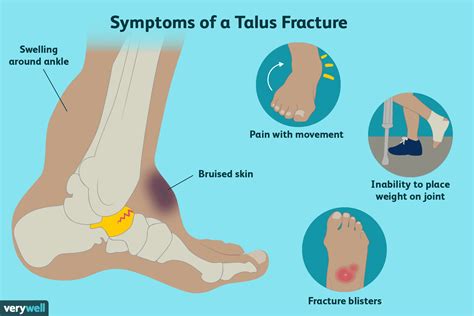 Talus Fracture Of The Ankle Overview | My XXX Hot Girl