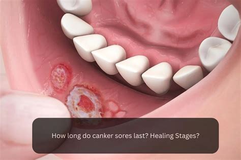 How long do canker sores last? Healing Stages - Exceleur