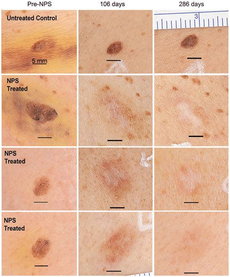 Pigmented seborrheic keratoses from a single subject shown before... | Download Scientific Diagram