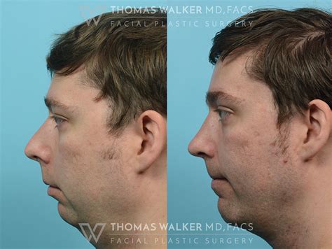 Septoplasty Before and After Photos Atlanta GA