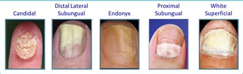 Proximal Subungual Onychomycosis Treatment