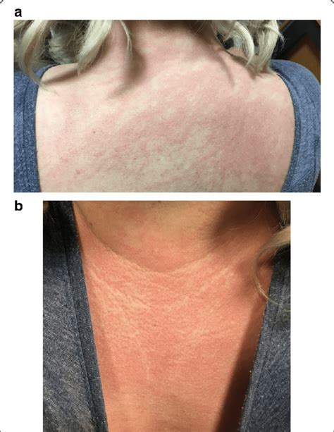 Lupus Rash On Neck And Chest