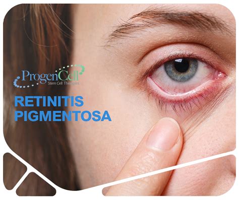 Retinitis pigmentosa. Symptoms, causes, treatments | Progencell