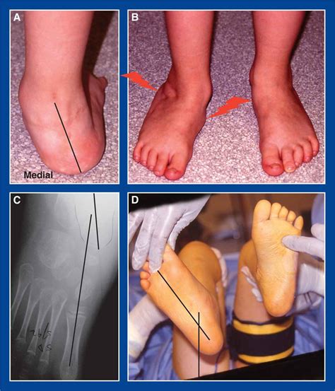 Ankle Deformity Types - Design Talk