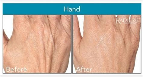 How to Rejuvenate Your Hands | Washingtonian Plastic Surgery