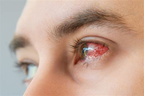 Dry eye disease alters how the eye’s cornea heals itself after injury - Medical Update Online