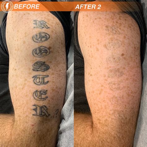 The Tattoo Removal Co.-Laser Tattoo Removal Adelaide