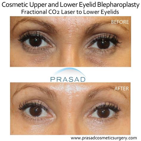 Laser Treatment for Dark Circles Under Eyes | Dr. Prasad Blog