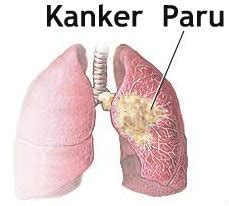 Pengobatan Kanker Paru Dengan Cryosurgery - Education Articles