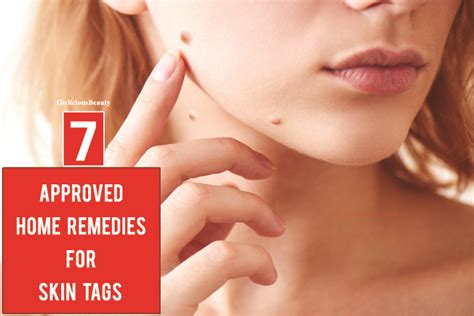 Approved Home Remedies For Skin Tags - Girlicious Beauty