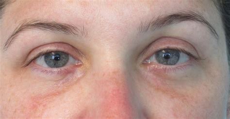 CO2 Laser Xanthelasma Removal Before and After Photos • Dr. Cameron Rokhsar