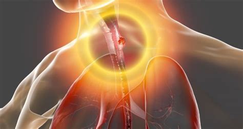 What to look out for: Symptoms of oesophageal cancer